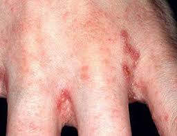 Image result for scabies norvegica