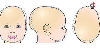 Yeni doğan bebeklerin kafa bölgesinde bıngıldak olarak tabir edilen yerlerinde görülen, ciltteki yağ dokusu ve epitel artıkların tozla birleşerek oluşturduğu plaklara konak denir. Bebeklerde Kafa Sekil Bozuklugu Uz Dr Dundar Yaykiran