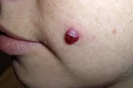 Image result for Pyogenic Granuloma