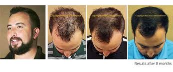 Could laser therapy promote new hair strands? Laser Hair Treatment Online Discount Shop For Electronics Apparel Toys Books Games Computers Shoes Jewelry Watches Baby Products Sports Outdoors Office Products Bed Bath Furniture Tools Hardware Automotive Parts