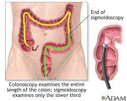 When is a colonoscopy necessary? Colorectal Polyps Medlineplus Medical Encyclopedia