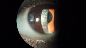 Keratitis is een aandoening waarbij het oog is het hoornvlies , de heldere koepel op het vooroppervlak van het oog, wordt ontstoken. Nummular Keratitis Wikipedia