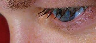 Olhos lacrimejantes - lacrimejando, lágrimas constantemente