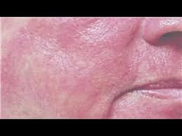 See full list on wikihow.com Skin Care Answers How To Reduce Redness On The Face Youtube