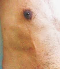 What are the other names for this condition? Colm Mccarthy Mdcm On Twitter One Does Not Simply Diagnose Mondor S Disease Meded Lotr Crossover