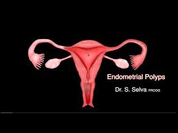 Adenomyosis can cause menstrual cramps, lower. Video 6 1 Endometrial Polyps Youtube