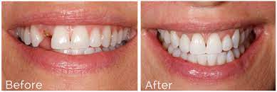 Dental Implant Cost In India Dental Implants Cost Tooth Implant Cost Teeth Implants