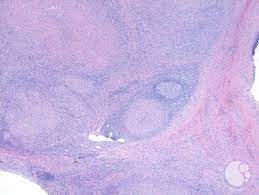 Since completion lymph node dissection was part of the surgical treatment, the routine practice of theoretically, however, only patients with disease in additional nodes in the same basin accurate staging, and in turn accurate prognosis assessment, has become a critical issue in light of the new. Necrotizing Granulomatous Lymphadenitis