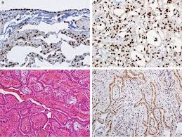 Maybe you would like to learn more about one of these? Bap1 Brca1 Associated Protein 1 Is A Highly Specific Marker For Differentiating Mesothelioma From Reactive Mesothelial Proliferations Modern Pathology