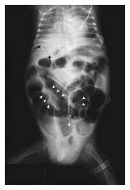 Image result for Necrotizing Enterocolitis