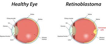 Such signs include a change in vision where an individual's sight is blurry, or they see flashes of light, floaters or zigzags. Retinoblastoma Aoa