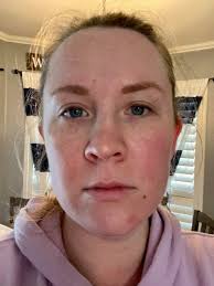 ISO A product for my face..I had a chemical peel