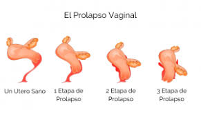 Prolapso De Organos Pelvicos Foundation For Female Health Awareness