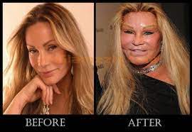 If you're getting ready to have lung surgery or know someone who is, understanding what the different procedures involve. Top 9 Worst Celebrity Plastic Surgeries Bad Celebrity Plastic Surgery Celebrity Plastic Surgery Bad Plastic Surgeries