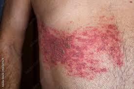 Image result for Varicella zoster on human skin