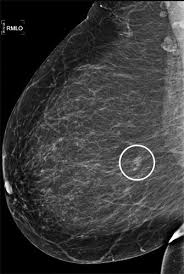 How much do mammography techs make. Additional Breast Cancer Detection At Digital Screening Mammography Through Quality Assurance Sessions Between Technologists And Radiologists Radiology