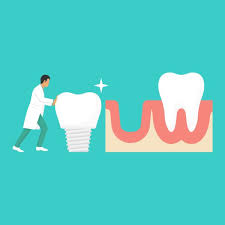 How Long Do Dental Implants Take To Heal Healthy Smiles Family Dentistry Llc Lagrange Georgia
