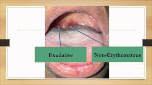 Jun 03, 2020 · emory department of gynob on instagram: Follicular Tonsillitis Exudative By Mohamed Taryam