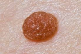 It affects people of all races, genders and ages, which is why it's absolutely critical for americans to learn about. Moles Nhs
