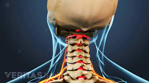 Maybe you would like to learn more about one of these? What Is Cervical Radiculopathy