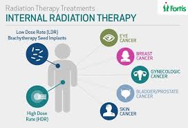 Radiation Therapy In Bangalore Radiation Therapy Radiation Gynecological Cancer