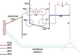 Image result for Delayed Transition from Fetal Circulation