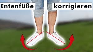 Fuss Zeigt Nach Aussen Entenfuss Entengang Korrigieren Ursache Sofortlosung Youtube