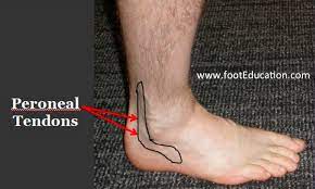 Find it here on amazon: Peroneal Tendonitis Footeducation