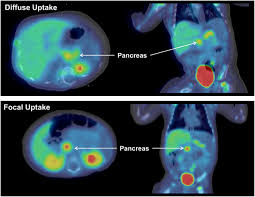 Check spelling or type a new query. Pancreatic Uptake And Radiation Dosimetry Of 6 18f Fluoro L Dopa From Pet Imaging Studies In Infants With Congenital Hyperinsulinism