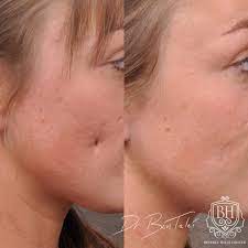 Scar Piercing Mole Removal Before Afters Beverly Hills Center
