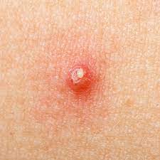 7 cara hilangkan selsema dan hidung tersumbat (tips dan via mediamaklumat.com. 6 Cara Mengobati Bisul Di Pantat Secara Alami Yang Aman Dan Efektif Hot Liputan6 Com