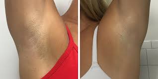 After each laser hair removal treatment, the hair will shed from the damaged follicles. I Tried Laser Hair Removal Under My Arms And I Ll Never Shave Again Self