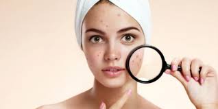 Yorgunluk Ve Stres Sivilce Problemine Sebep Oluyor Memurlar Net