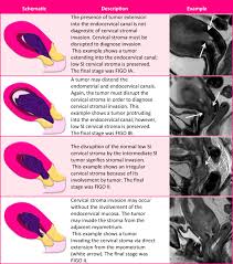 It occurs due to the abnormal growth of cells in the lining. Endometrial Cancer Mri Staging Updated Guidelines Of The European Society Of Urogenital Radiology Springerlink