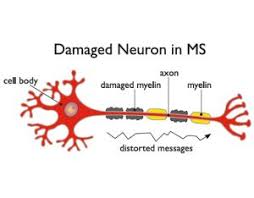 Maybe you would like to learn more about one of these? Multiple Sclerosis A Closer Look At Stem Cells