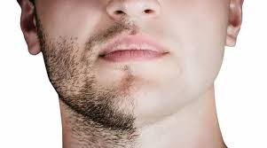 Praseedha clinic provides the best cosmetic surgery of the face, hair transplant surgery and dentistry in chennai. Hair Transplant From Beard To Head Ahd Hair Transplant Clinic