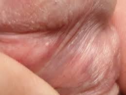 Hi Is This A Pimple Or Tyson Gland? | Penis Disorders | Forums | Patient