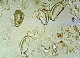 Image result for Pinworm
