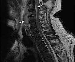 Image result for Spinal Epidural Abscess