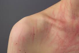 Image result for Dermatographism