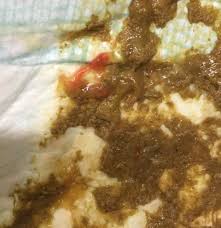 Maybe you would like to learn more about one of these? Seorang Kanak Kanak Pokes Dengan Darah Penyebab Pada Bayi Darah Di Dalam Bangku Kotoran Dengan Darah