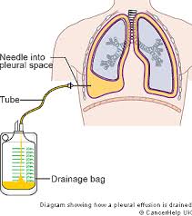 Treatment may be directed at removing the fluid, preventing it. Nanda Nursing Interventions Nursing Interventions For Ineffective Breathing Pattern Pleural Effusion