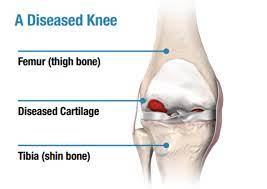 Total Knee Replacement Surgery Types Treatment Recovery Meril Life