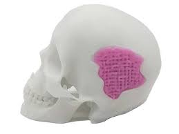 A new bone substitute made out of … 3D-printed glass?