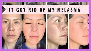 Maybe you would like to learn more about one of these? The Only Product That Has Gotten Rid Of My Melasma Seebiedeebie Musely Youtube