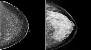 What should women with breast implants do about screening mammograms? Should You Worry About Dense Breasts Everyday Health