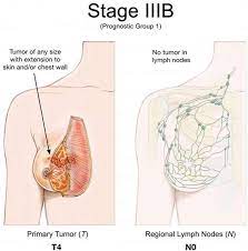 The treatment plan is generally based on the stage of the breast cancer. Breast Cancer Causes Signs Symptoms Types Treatment