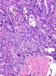 Image result for Strongyloides