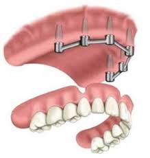 Dental Implant Dentist In Shreveport La Get 1000 Toward Implant Care Dental Implants Cost Teeth Implants Implant Dentist