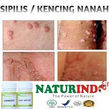 Pengobatan siflis atau raja singa ini akan lebih efektif jika dilakukan ketika tahap awal. Obat Sipilis Kencing Nanah Raja Singa Paling Ampuh Shopee Indonesia